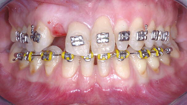 Ritrattamento ortodontico e riabilitazione mediante l’utilizzo di impianto narrow platform in un caso di agenesia di un laterale con spazio medio-distale ridotto