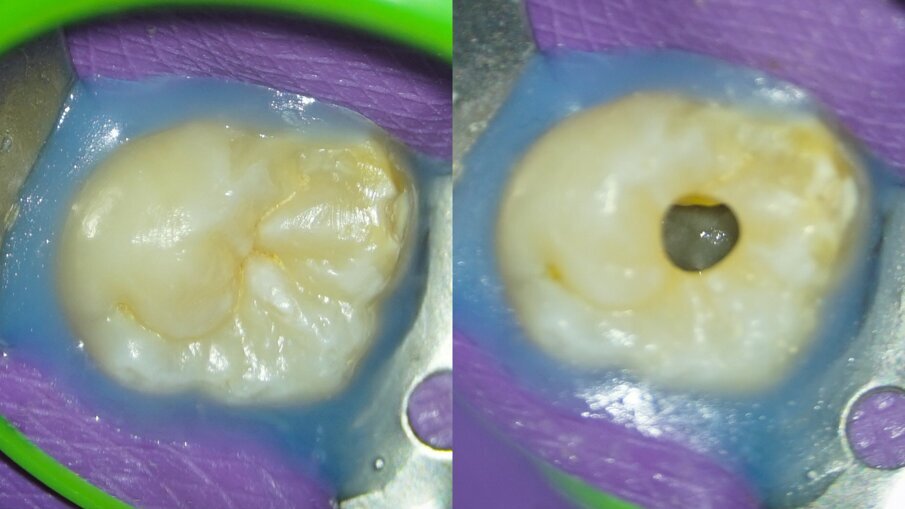 Figs. 7a & b: Clinical photographs of the tooth just before initiating the root canal therapy (a) and just after nishing the endodontic access opening (b).