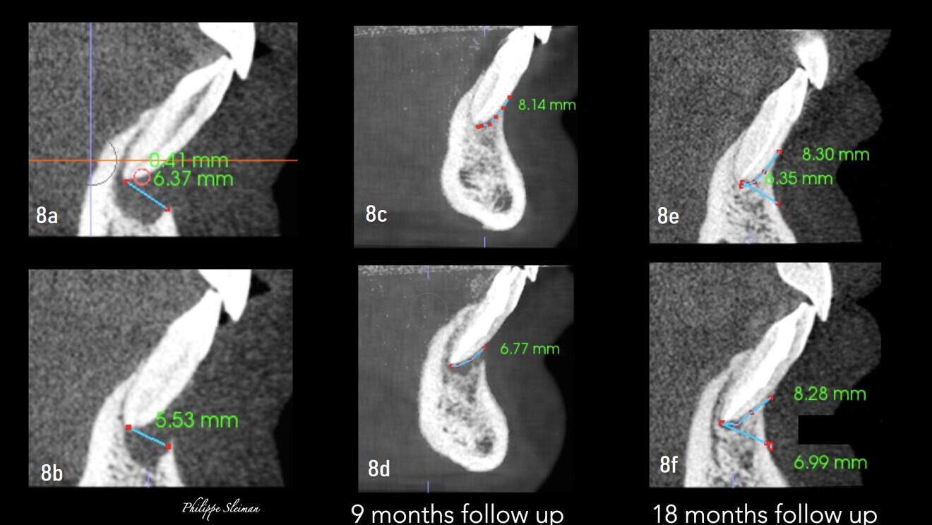 Figs. 8a–f: Absence of cortical bone and apical bone around both central incisors (a & b). Nine-month follow-up radiographs (c & d). Eighteen-month follow-up radiographs (e & f).