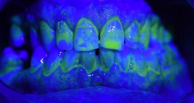 Il Tailored Brushing Method (T.B.M.): un approccio efficace per il controllo del biofilm batterico