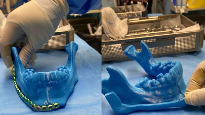 Surgeons in Tabuk reconstructed the jaw of 25-year-old patient with 3D printing