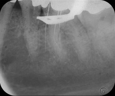 Afb. 2: Lengtefoto van de mesiale kanalen, waarbij een handvijl in de perforatie steekt