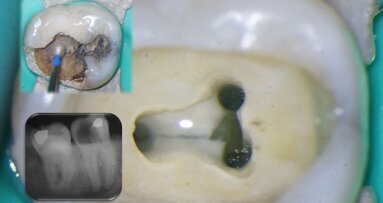 Three questions about the management of complex root canal anatomy