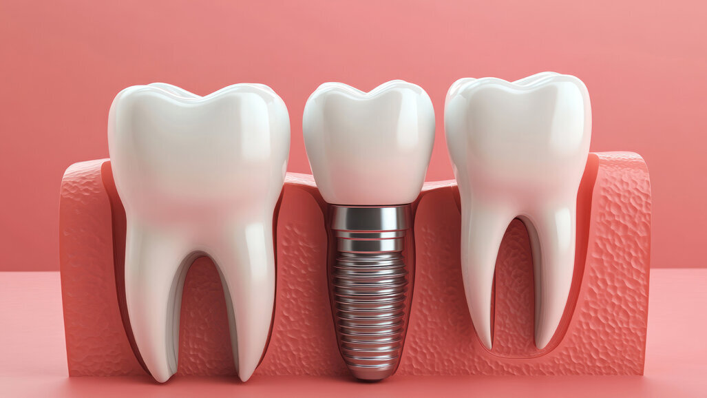 Titan im Fokus: Schweizer Forscherin untersucht Implantat-Grenzflächen