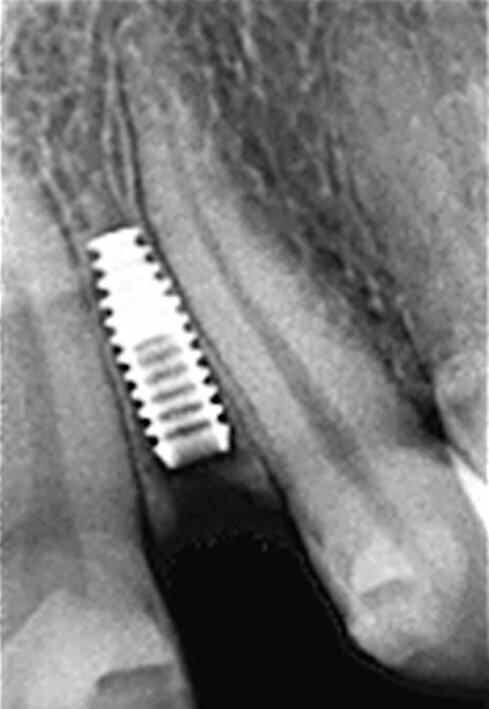 Fig. 7 : Présentation radiologique de la technique d’ouverture de l’espace interradiculaire. Il faut noter l’insertion des alésoirs manuels de 2,5 mm et 3,0 mm entre les racines, afin de préparer l’espace pour l’implant de Ø 3,0 mm, mis en place à 3,0 mm sous le niveau de l’os crestal.
