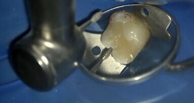 Laserowo wspomagane pokrycie bezpośrednie miazgi – opis przypadku