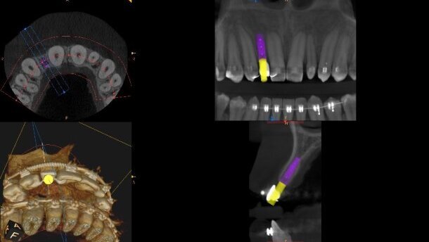 Wirtualne planowanie leczenia implantoprotetycznego – opis przypadków