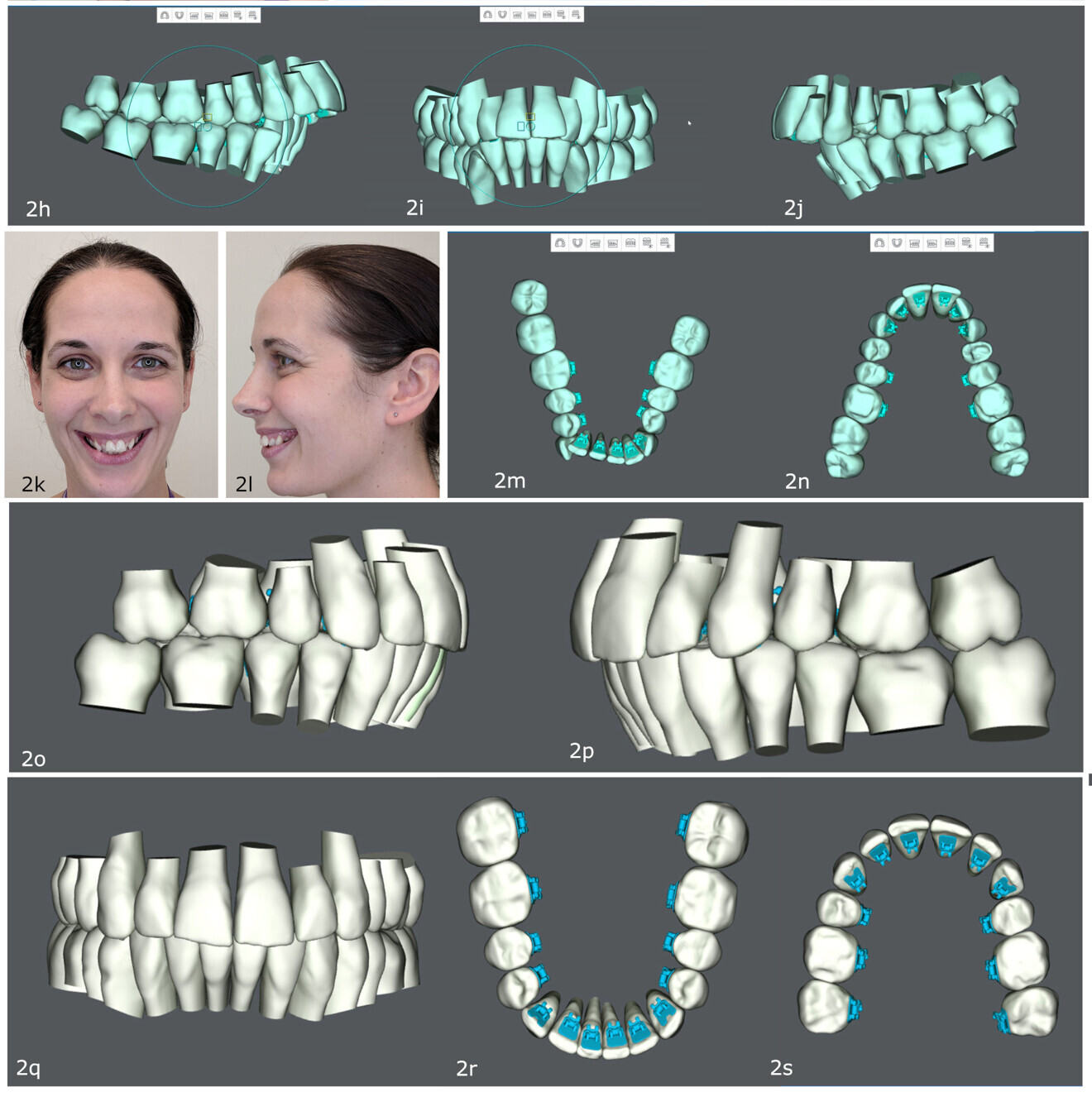 Figs. 2h–s: Digital treatment simulation in SureSmile (Dentsply Sirona) of treatment to be delivered through robotically bent lingual fixed appliances.