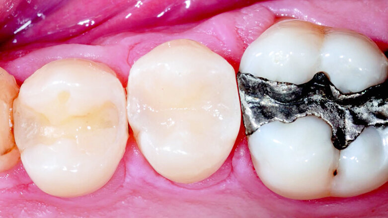 Class II DO on Second Bicuspid. Case Study