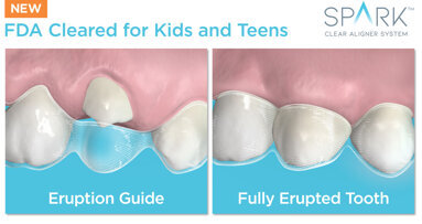 Ormco announces FDA approval to treat mixed dentition with Spark clear aligners