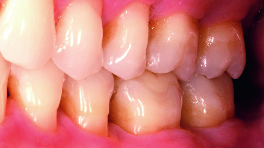 Fig. 1: Initial situation. The failed composite restoration covering a large part of the left mandibular first molar’s occlusal surface needs to be replaced.
