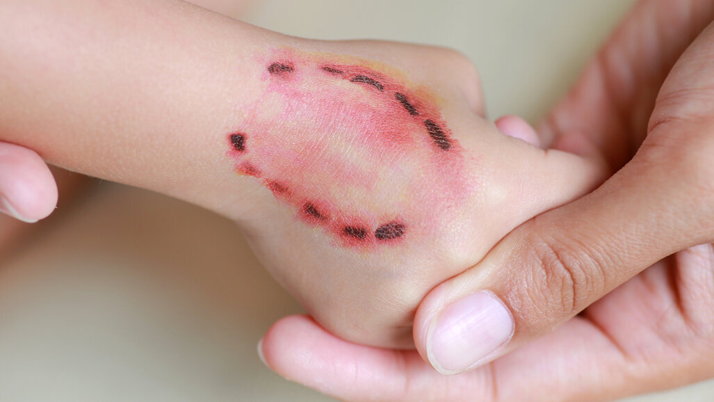 Forensic bitemark analysis lacks scientific research, can lead to wrongful convictions