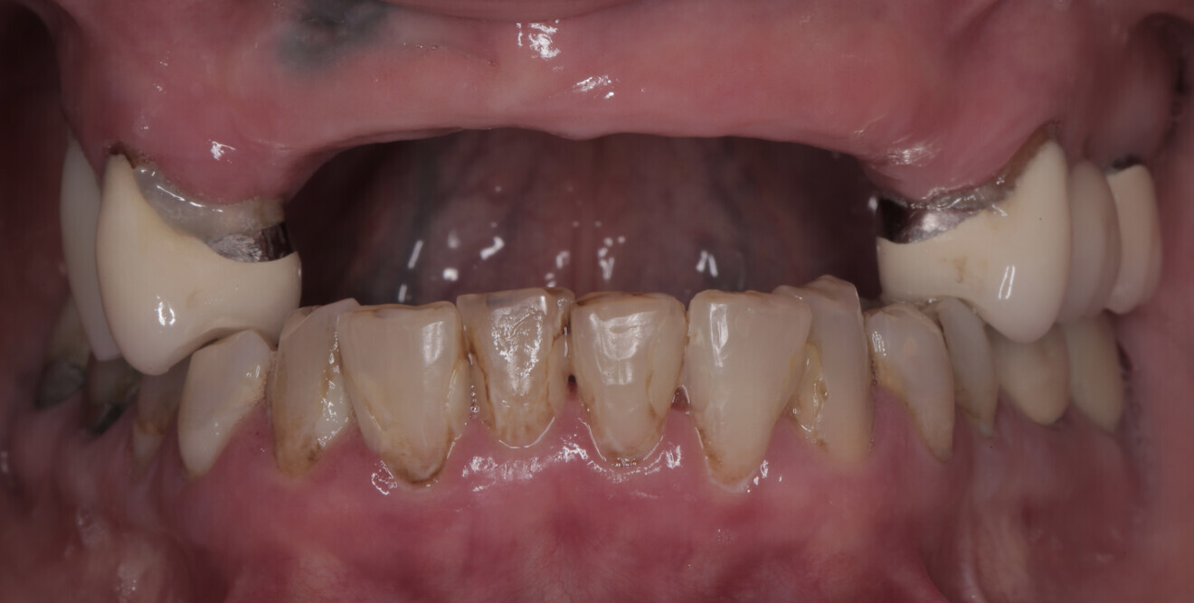 Fig. 2a: Frontal view of the initial presentation without the partial acrylic denture.