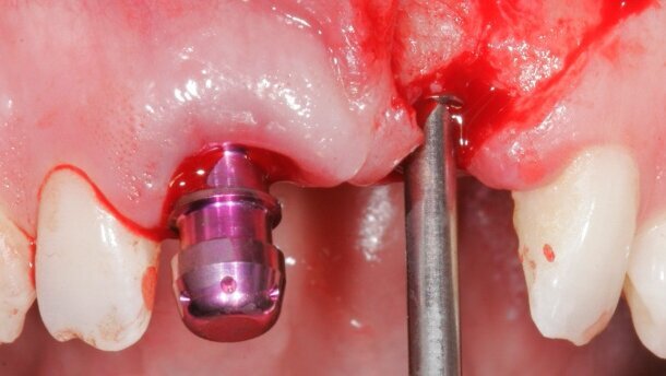 Estetyka różowa i biała – implantacja w odcinku przednim z natychmiastowym obciążeniem przy użyciu implantów MIS C1