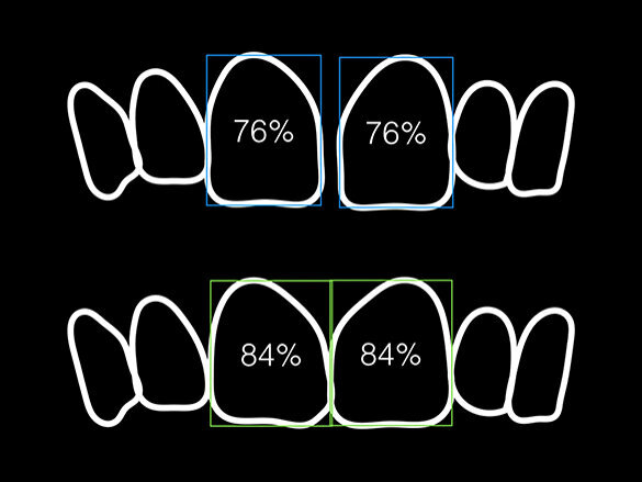 Figura 2. Proporciones reales e ideales de los incisivos centrales.