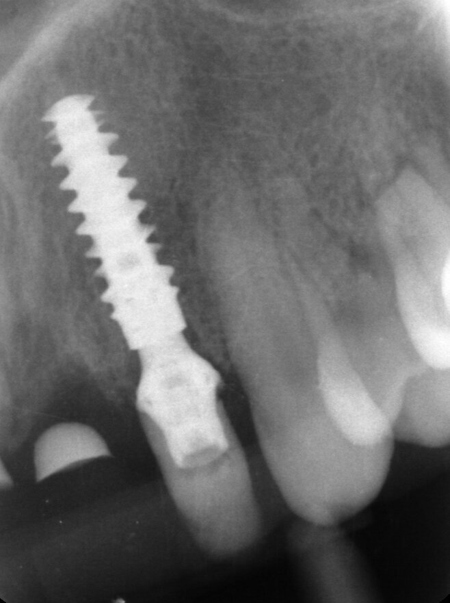 Fig. 70 - Rx finale.