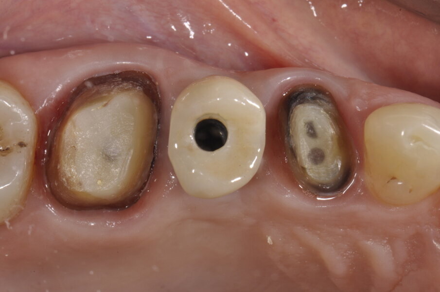 Fig. 14 - Clinicamente si potranno fare le varie prove singolarmente prima di definire la fissazione dei vari elementi protesizzati.