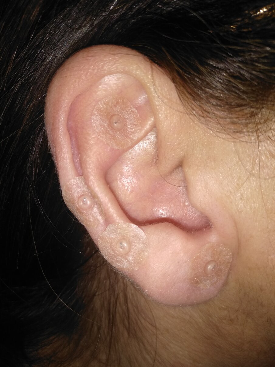 Fig. 2 - Cerotti con mini aghi incorporati, per la stimolazione dei punti di interesse domiciliare.