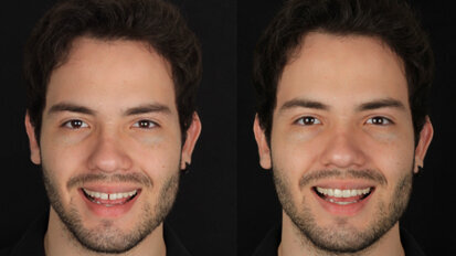 Restauración mínimamente invasiva con carillas de base cerámica