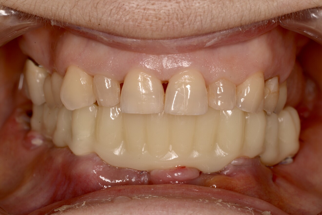 Fig. 8b: Delivery of the provisional restoration the day after the surgery.