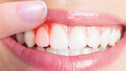 Parodontitis: Zahnärzte fordern bessere Nachsorge