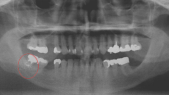 Foreign bodies discovered during routine dental treatment