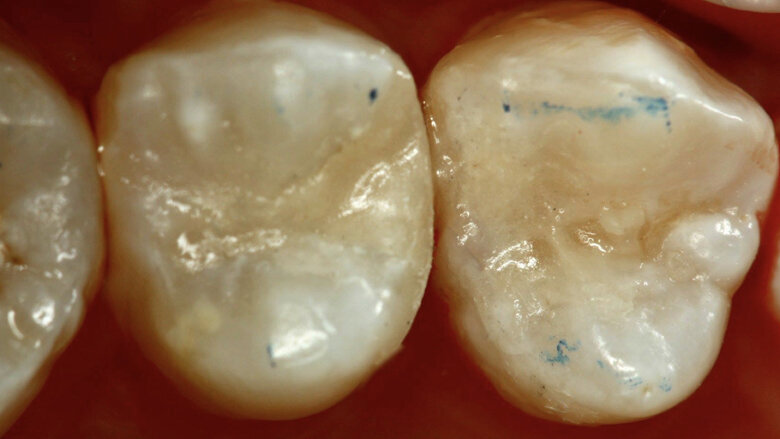 Figura 31. La restauración final.