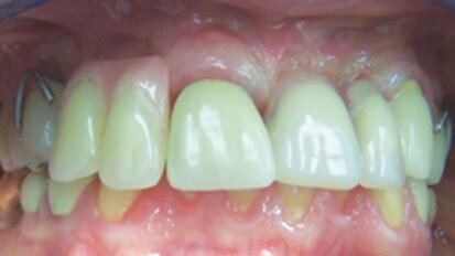 Fracture d'implant: Un regard sur les mécanismes physiques de l'échec