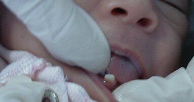 Dientes natales y neonatales