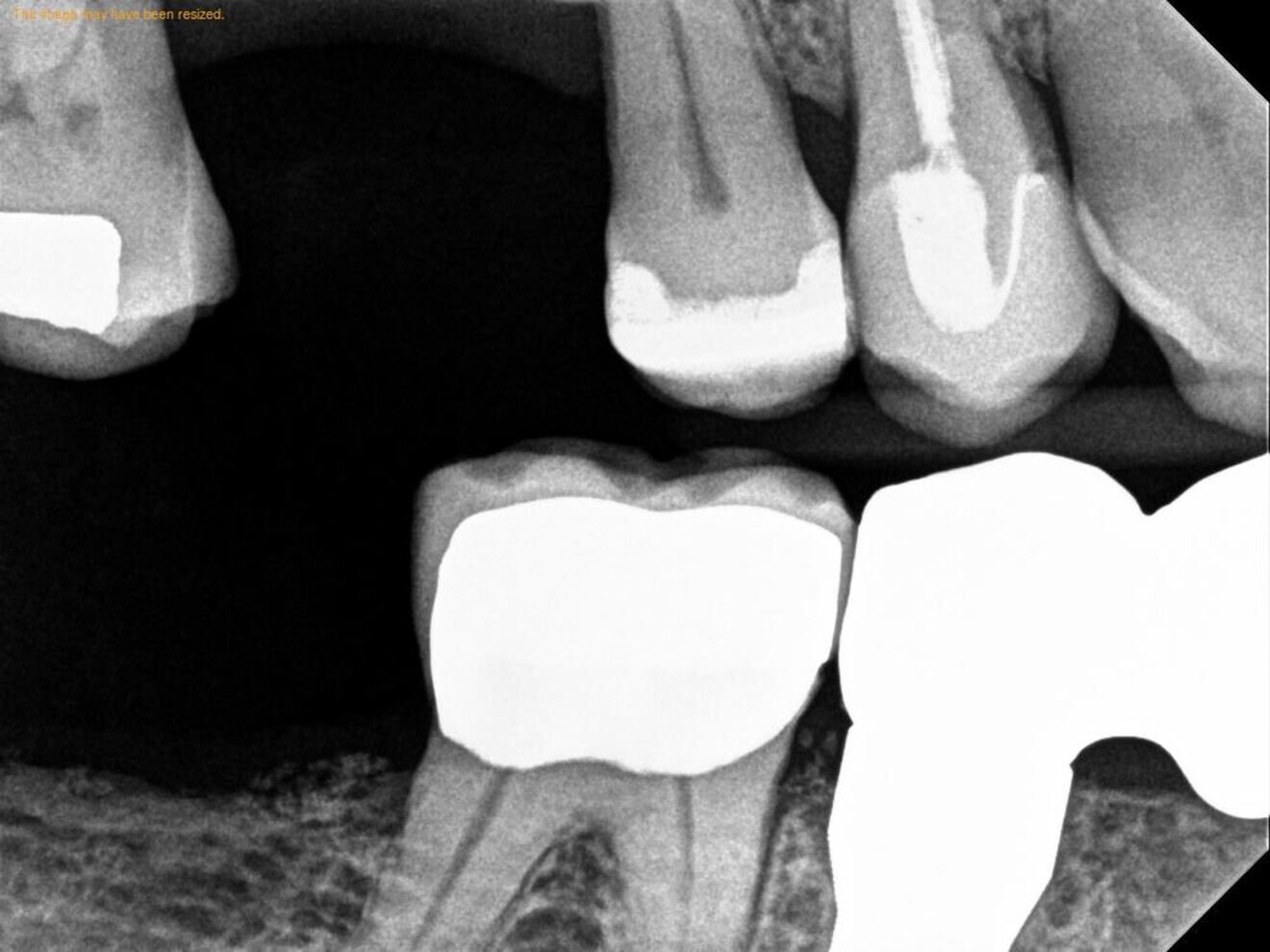Figs. 17a–c: Final radiographs showing the bone levels and final restoration.