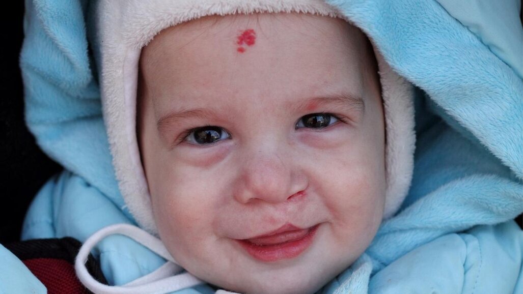 LCMD spreads awareness on Craniosynostosis and Distraction Osteogenesis