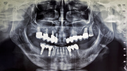 Reduced radiation dose in maxillofacial radiology yields comparable diagnostic results, study says Reduced radiation dose in maxillofacial radiology yields comparable diagnostic results, study says