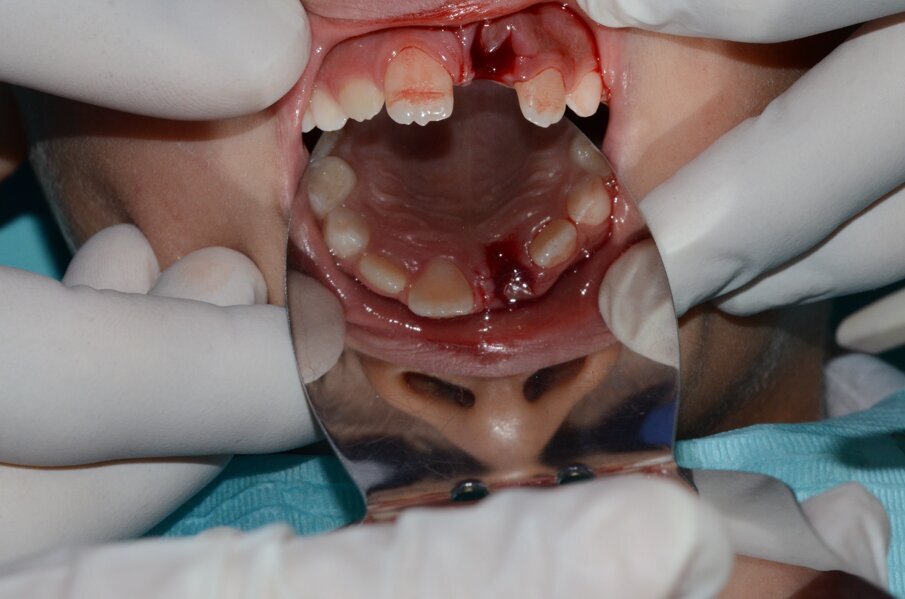 Figure 2: Palatal view of 21 socket. Notice the coagulum filled socket
