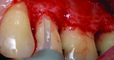 Utilisation du laser Er:YAG pour la chirurgie parodontale assistée par laser
