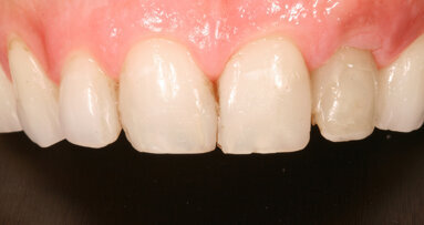 Top three trends influencing U.S. dental bone grafting industry in 2021