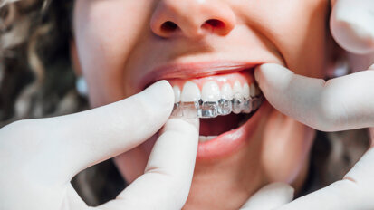 Ensuring predictable results in clear aligner therapy