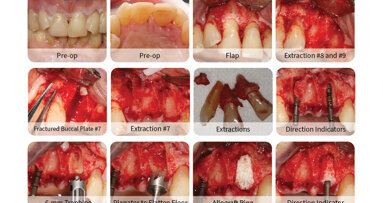The most versatile barrier membrane for periodontal applications