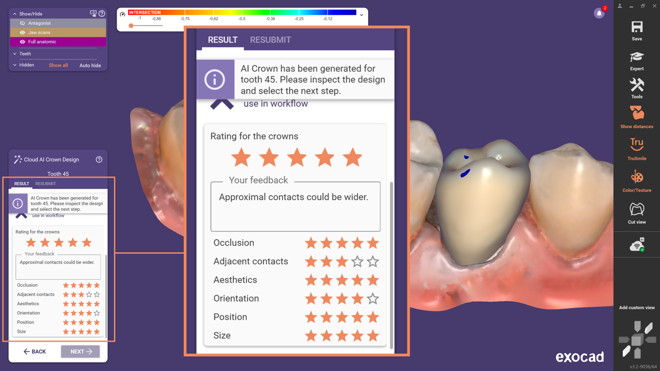 Fig. 6: The AI-suggested tooth shape is adjusted to the defined preparation margin and then used for the remainder of the design.