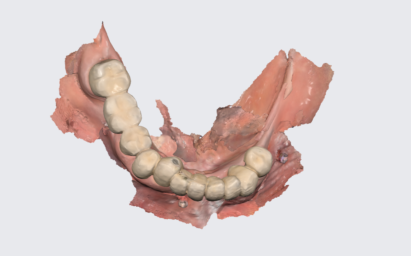 Figs. 2a & b: Intra-oral scans of the pre-op situation.