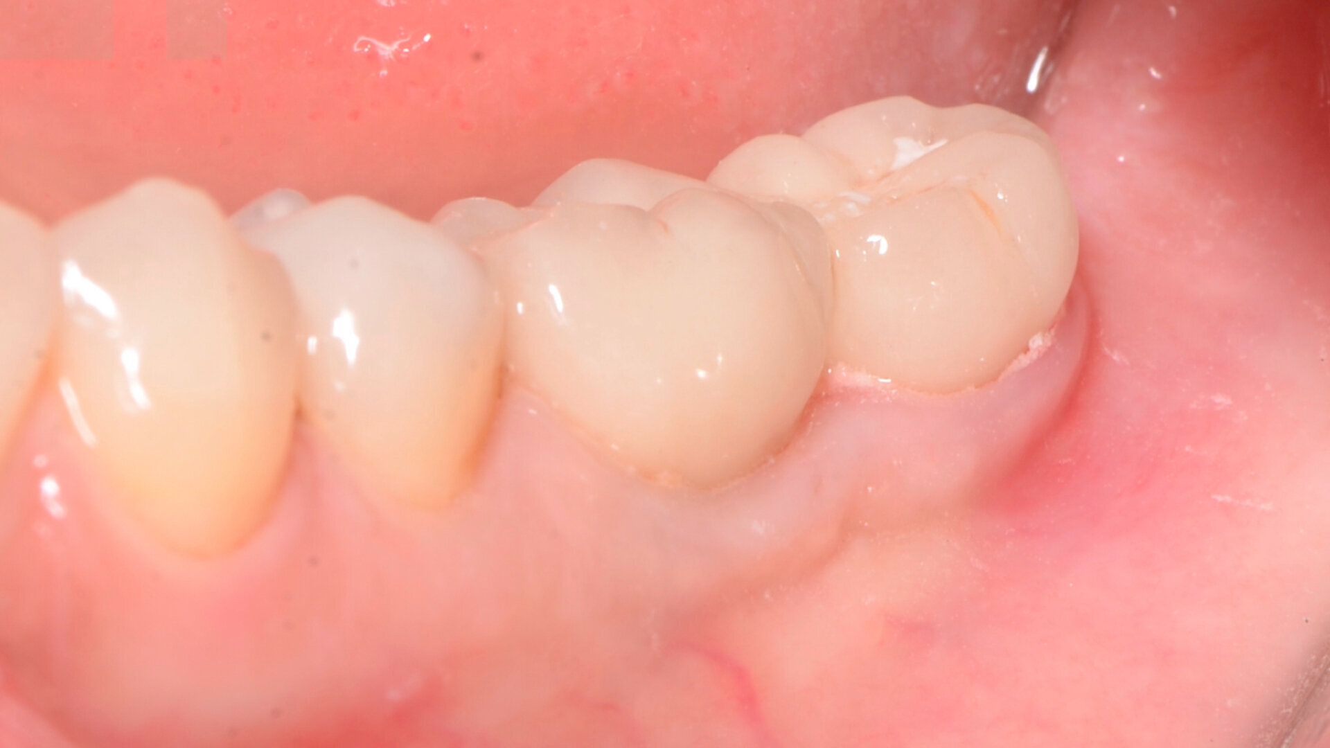 Technique Snake dans le traitement des défauts des tissus mous péri-implantaires postérieurs