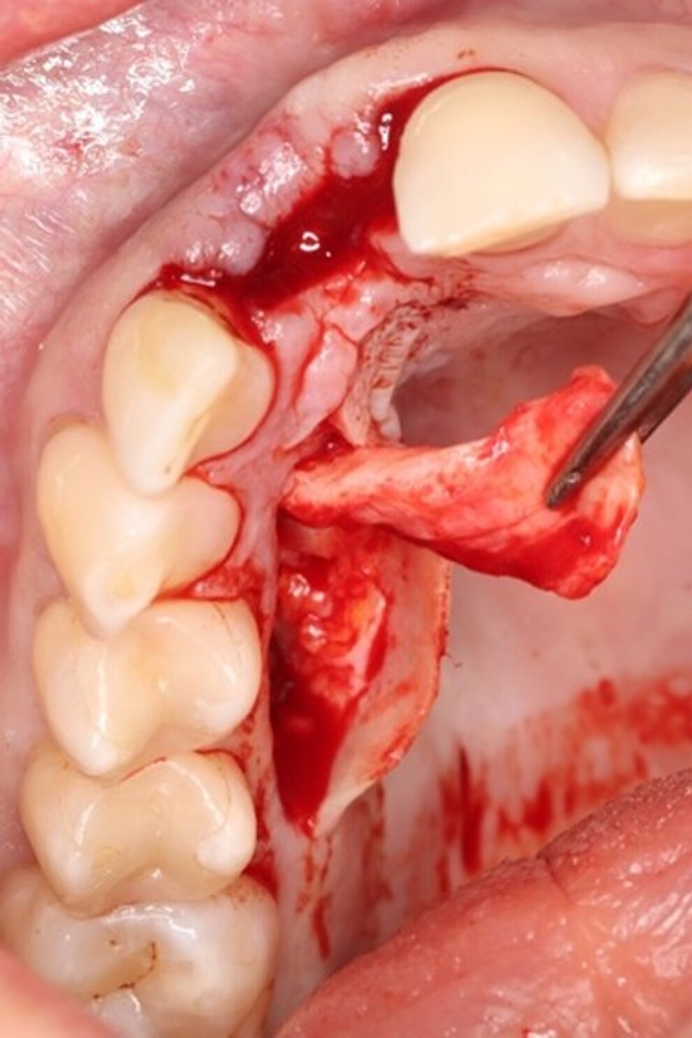 A pedicled palatal flap harvested from the palate for soft-tissue augmentation.
