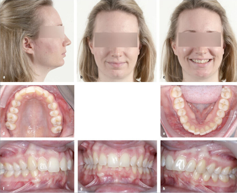 Figs. 1a–h: Facial and intra-oral photographs of a 35-year-old female patient with an increased overbite and a Class II relationship.