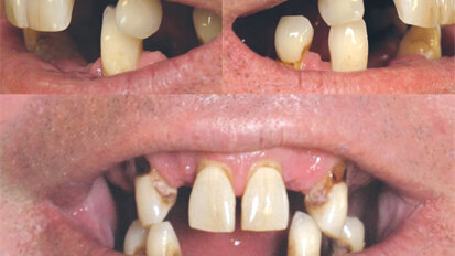 Una solución para cada arcada Una solución para cada arcada