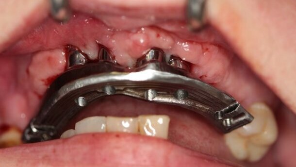 Kompromisowe leczenie implantoprotetyczne w strefie estetycznej