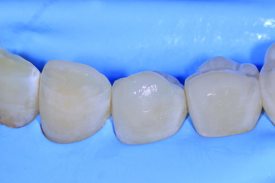 Figg. 6-9_Le superfici occlusali erose e/o abrase vengono ricostruite con strati sottili di smalto composito Enamel Plus HRi Bio Function. 