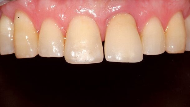 Ästhetische Versorgungen mit Kronen und Brücken im Frontzahngebiet