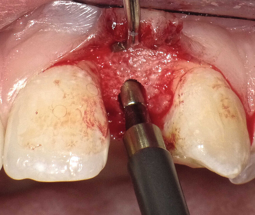 |Fig. 4 : Le dernier alésoir manuel de Ø 3 mm est prudemment introduit à la main entre les deux racines. La partie tranchante est dirigée vers la corticale palatine et l’axe de rotation est à un maximum de 45°. 
