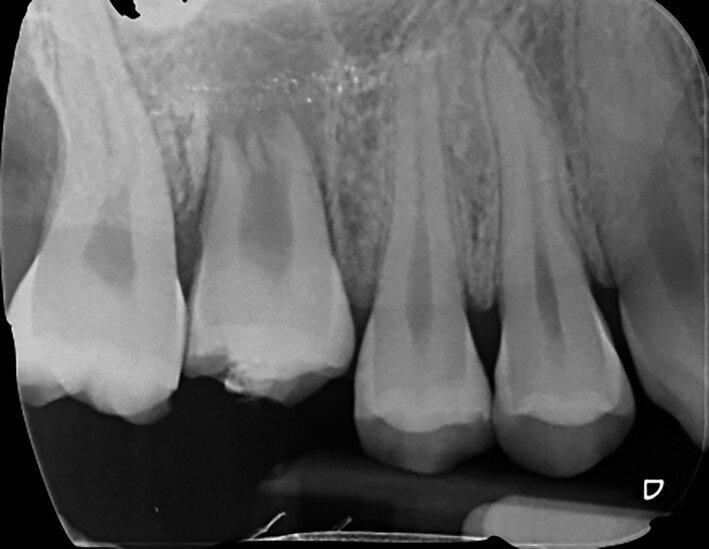 Fig. 19b: Radiographs: Immediately after transplantation.