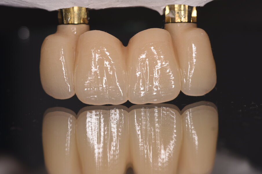 Fig. 27_Visione vestibolare del provvisorio sugli impianti con rispetto vestibolare dell’emergenza coronale nel riguardo del tunnel mucoso.