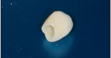 Implantes postextracción. ¿Una alternativa a la preservación alveolar?  Revisión de la literatura